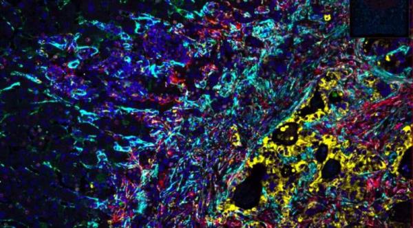 A step toward solving the riddle of tumor cell invasion